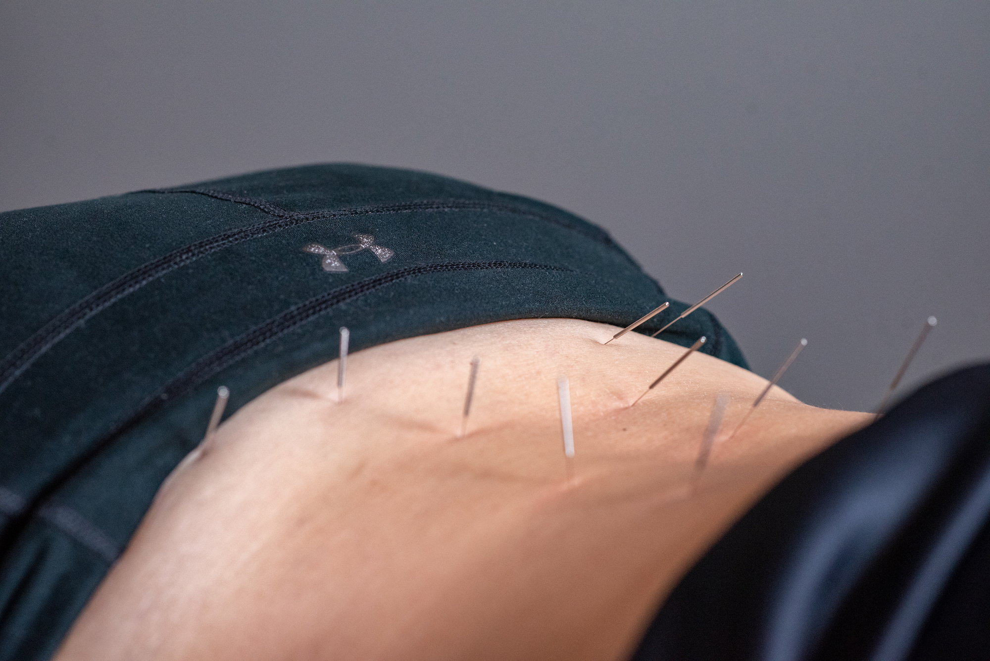 Accupuncture lower back