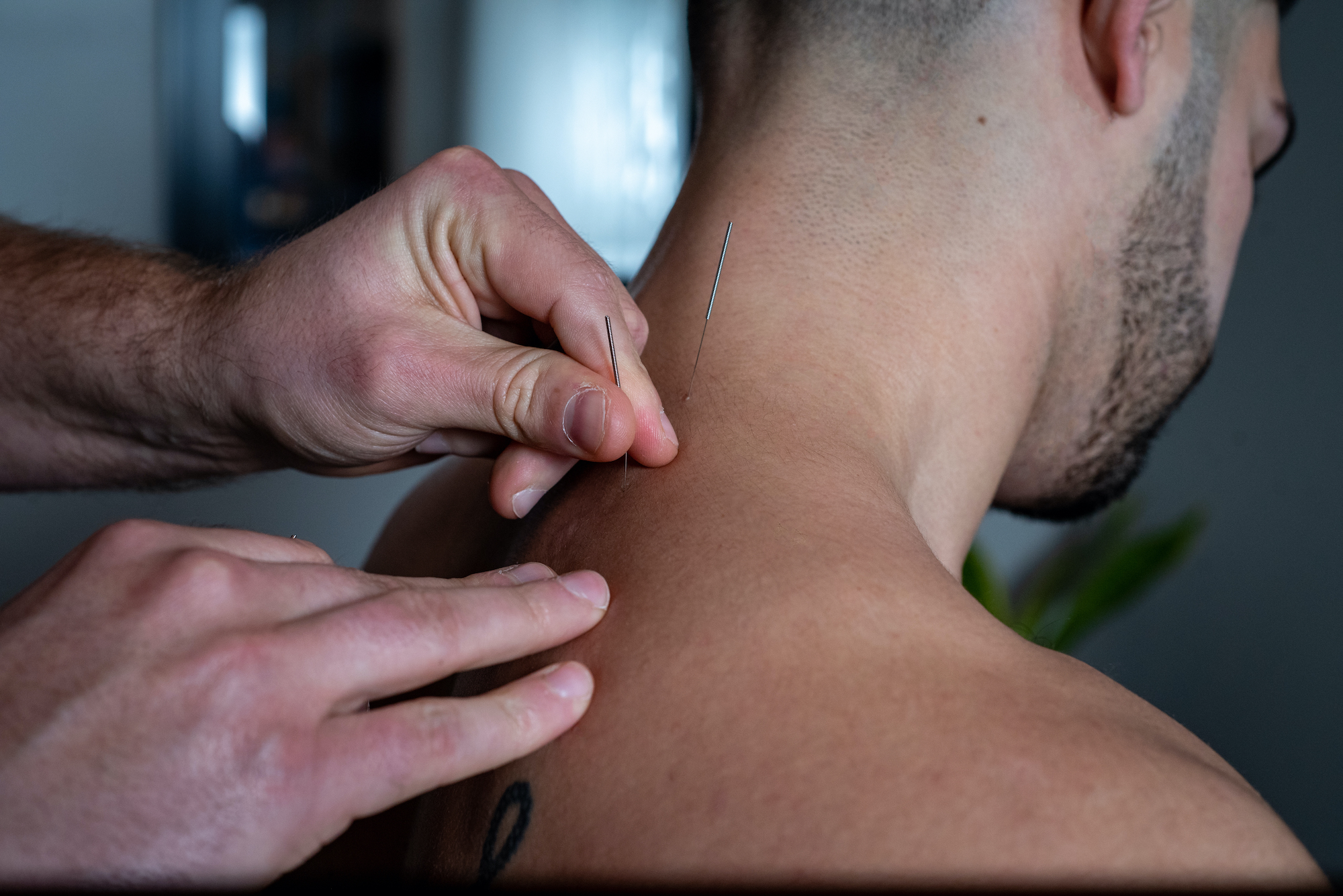 Acupuncture needle in neck