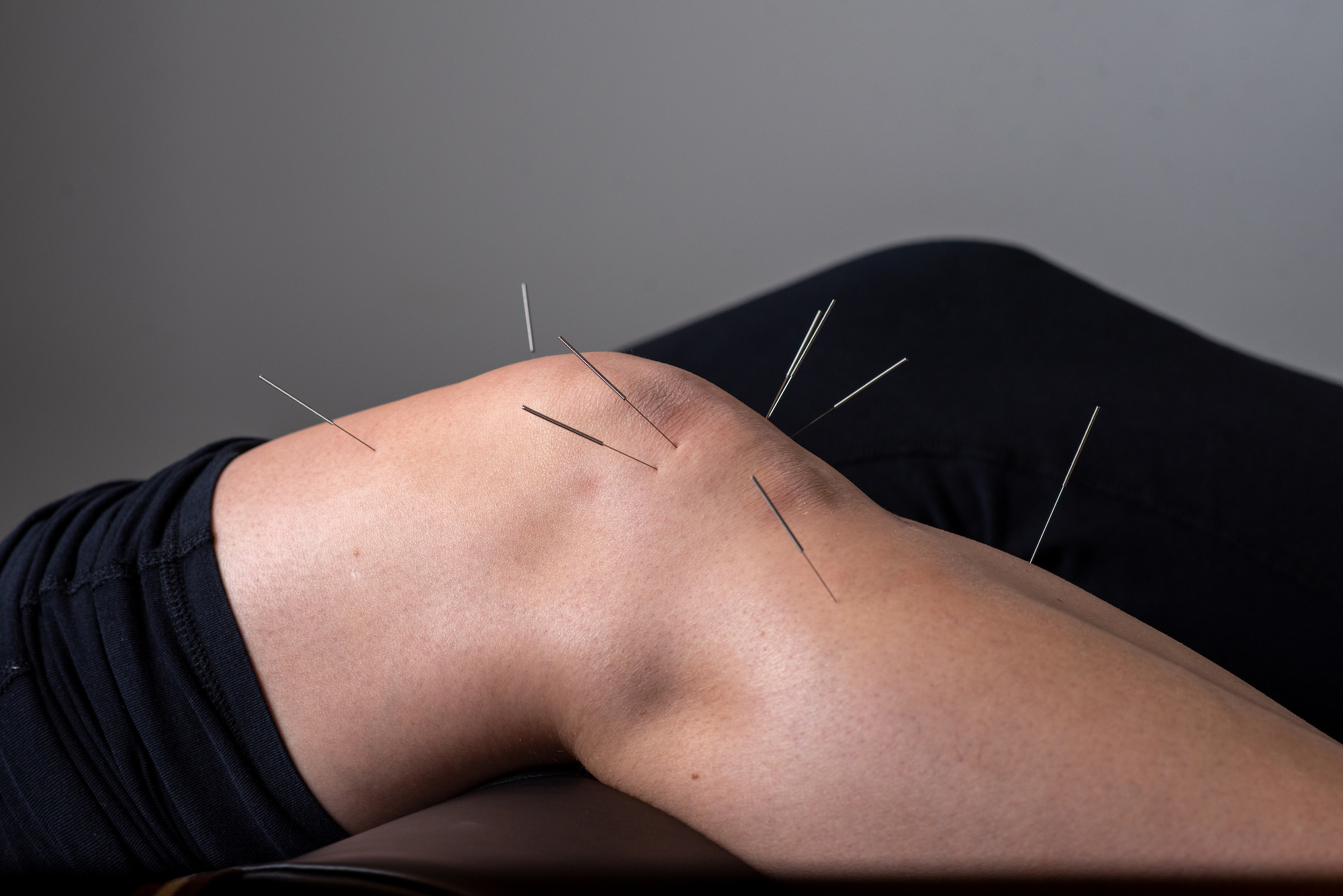Acupuncture in Knee